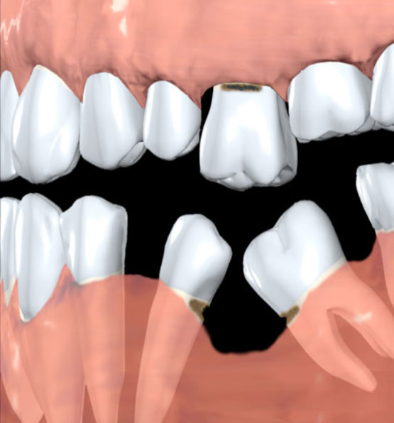 Dent De Sagesse, Implant Et Modèle De Dents. Image stock - Image du  distraction, santé: 13616123